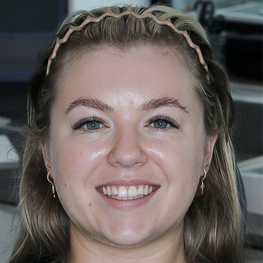 Composite veneers - before - Shannen - 3dental